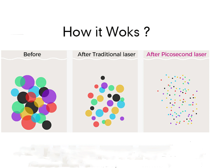 Commercial Tattoo Removal Machine Commercial Tattoo Removal Machine