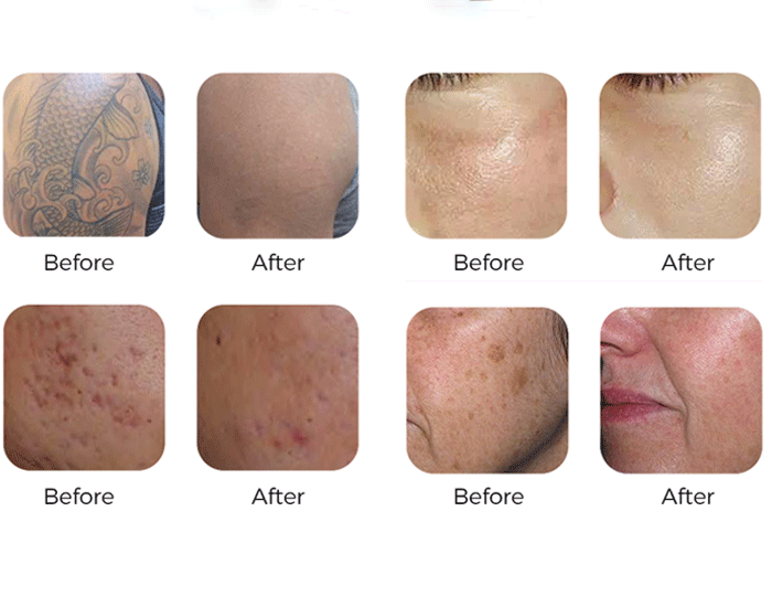 High-Quality pigment removal laser machine High-Quality pigment removal laser machine